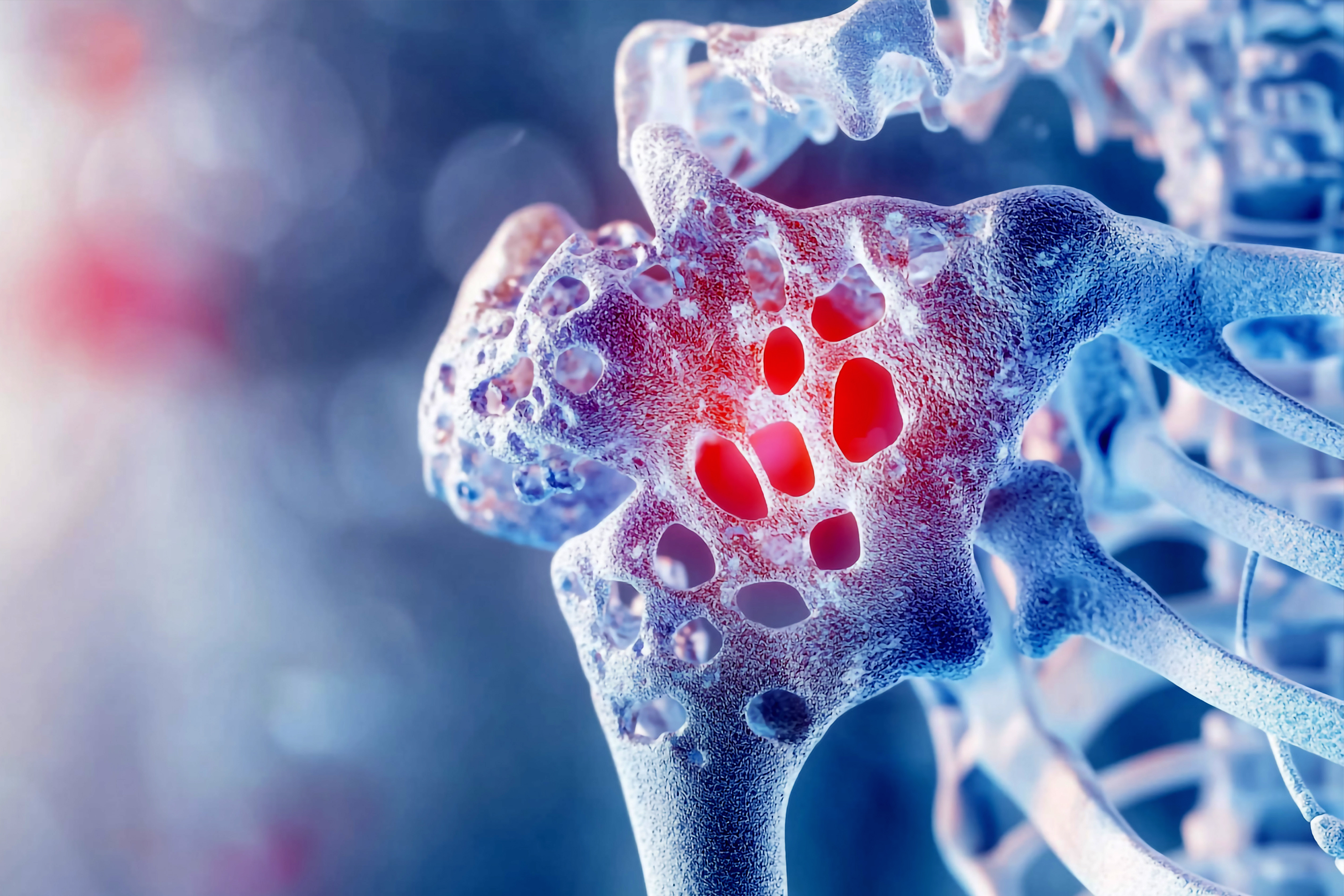 Osteoporosis
