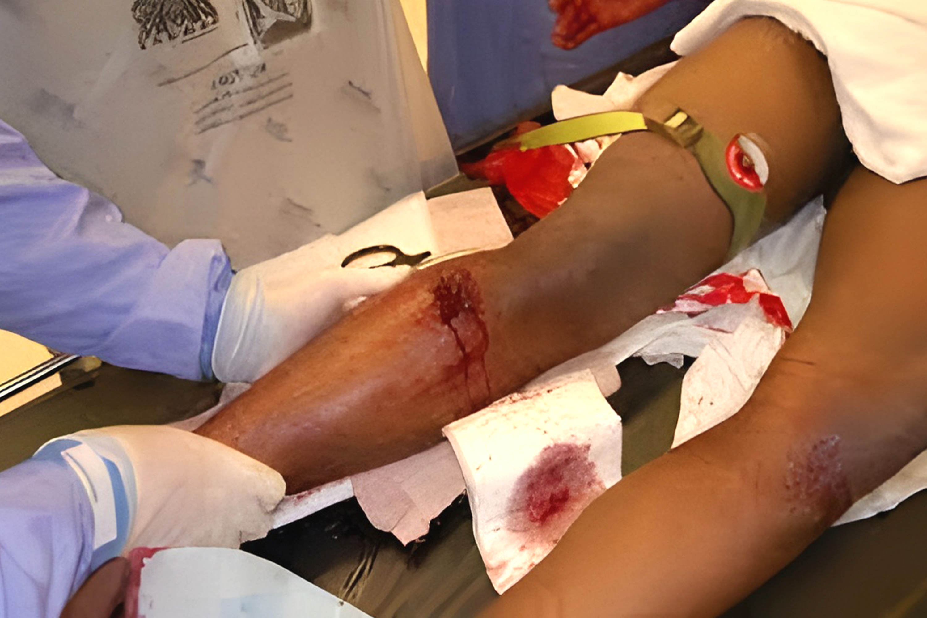 Trauma Management